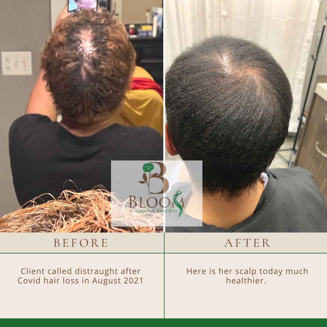 Scalp health transformation shown in before and after photos due to regular use of Organic Hair Growth Oil, emphasizing reduced dryness and increased hair follicle vitality.